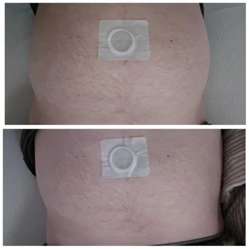 Australische Abnehm-Pflaster photo review